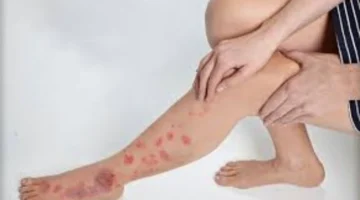 مرض نادر ينتشر بصمت.. أعراض تحذيرية تستدعي استشارة الطبيب فوراً